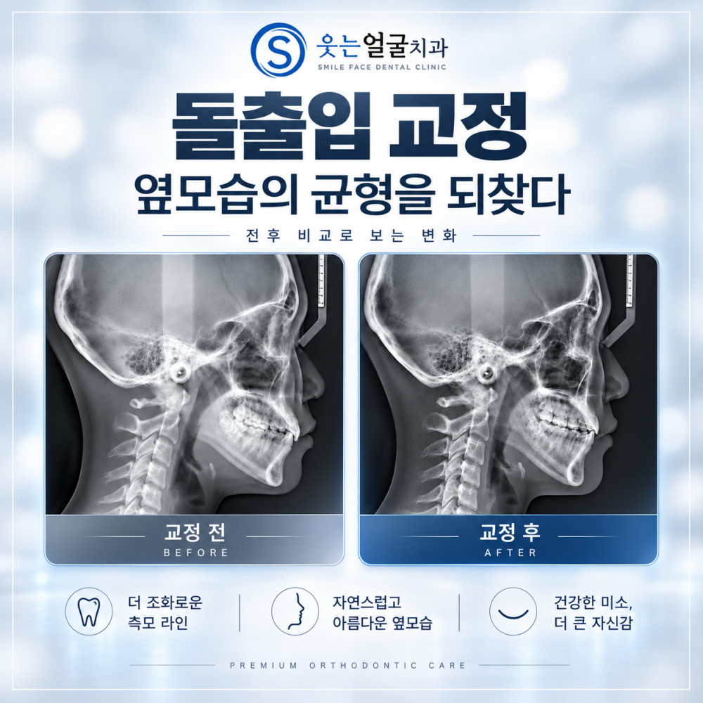 돌출입 교정 옆모습의 균형을 되찾다